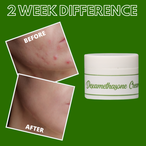 Greenika Dexamethasone Steroidal Cream