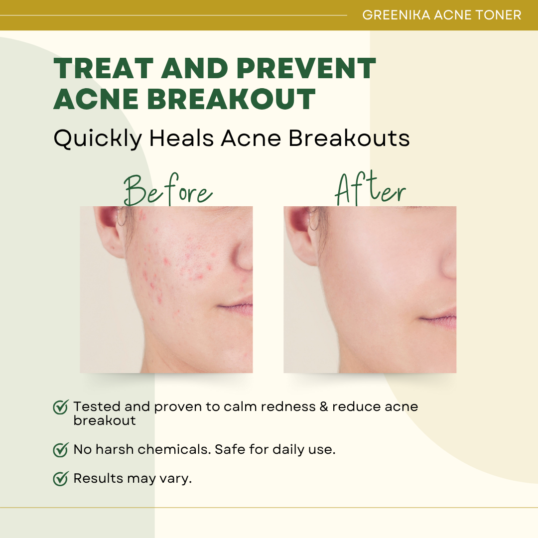 Greenika Acne Toner (Formerly Erythromycin 2% Solution)