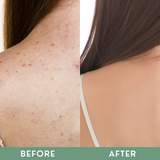 Greenika Acne-Free Acne Body Spray
