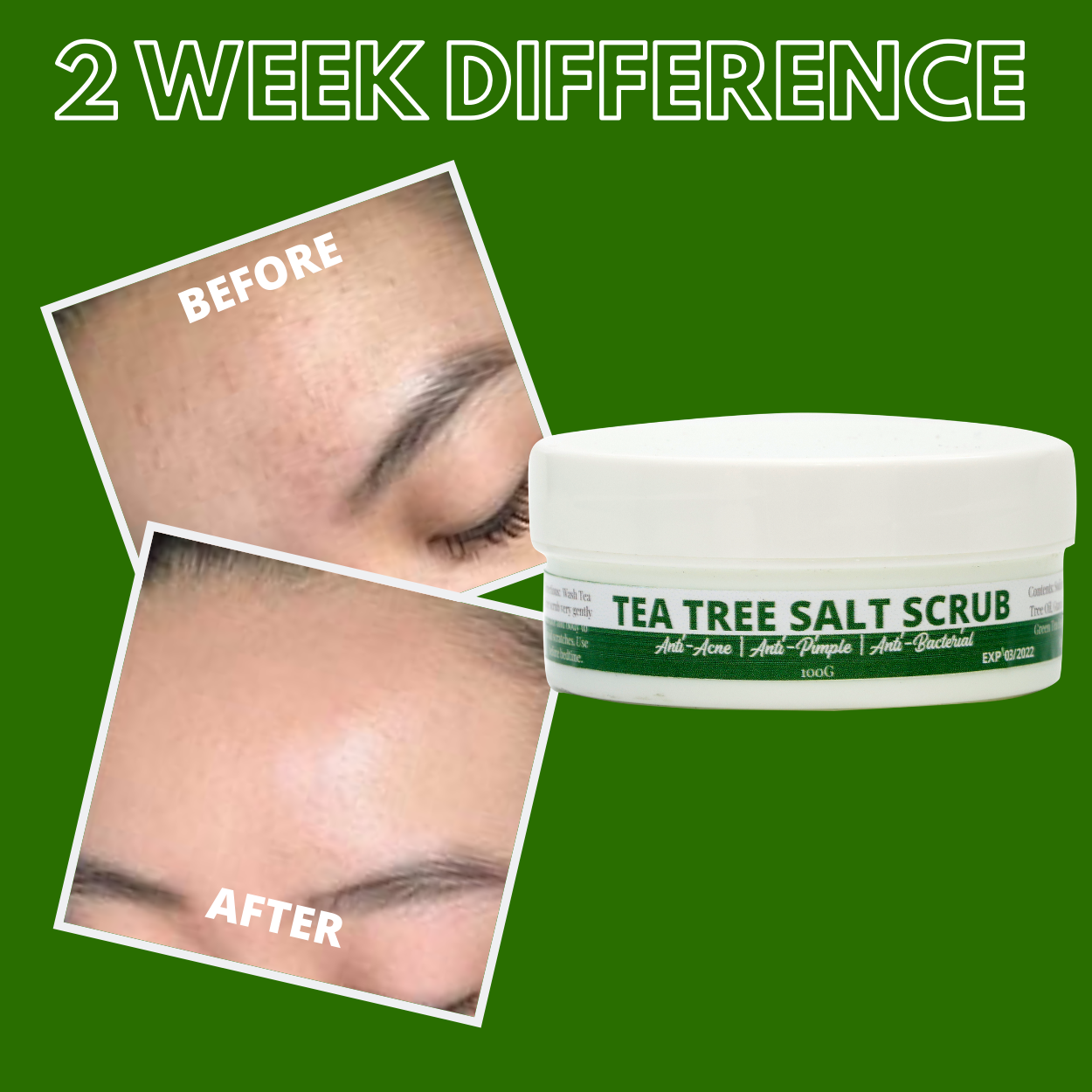 Greenika Tea Tree Anti Acne Anti Pimple Refined Salt Scrub