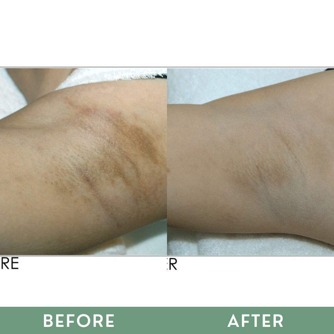 Greenika 7X Underarm Whitening Cream Extra Strength