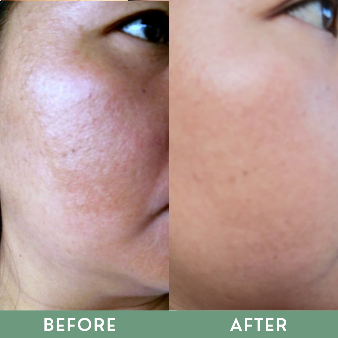 Greenika Anti Melasma Melaclear Dark Spot Remover Solution
