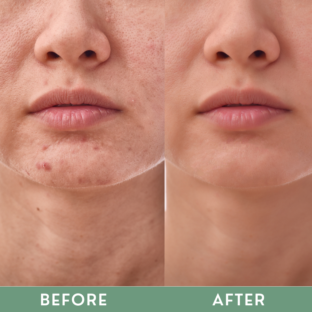 Greenika Vitamin C Serum Anti-Inflammatory for Microneedling Dermaroller Serum
