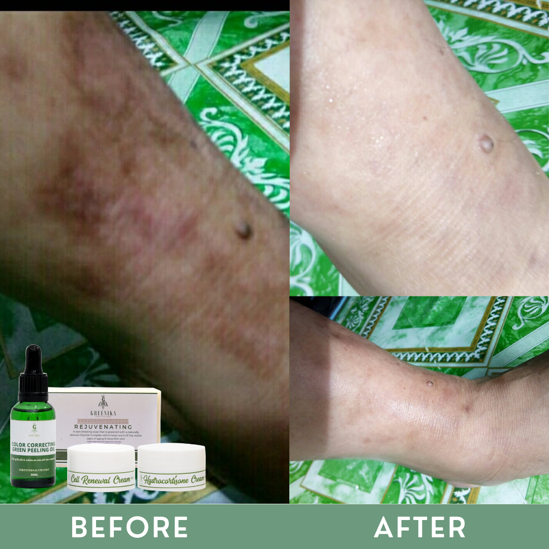 Greenika Scar Remover 4 PC Set
