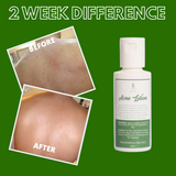 Greenika Acne Lotion for Arms Back and Body