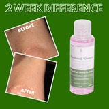 Greenika Blackhead Remover Whitehead Remover Facial Toner