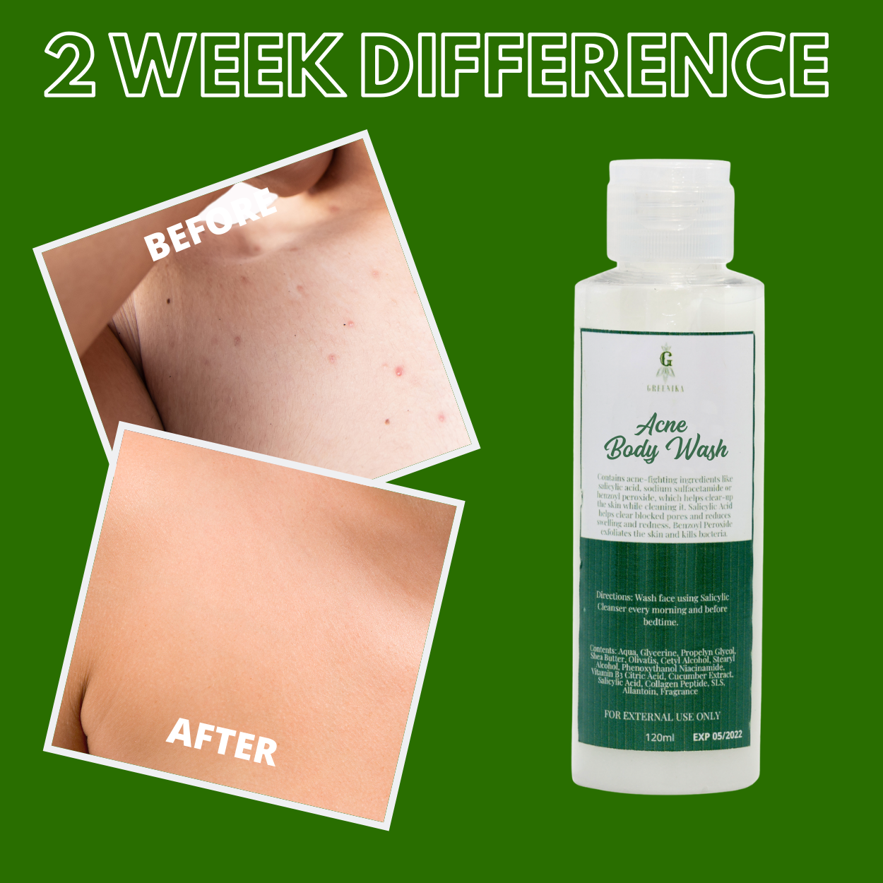 Greenika Body Acne Healing Body Cleanser