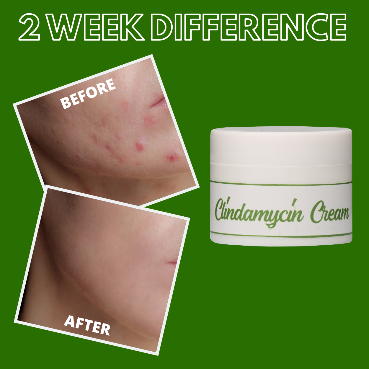 Greenika Clindamycin Cream Anti-Acne Gel