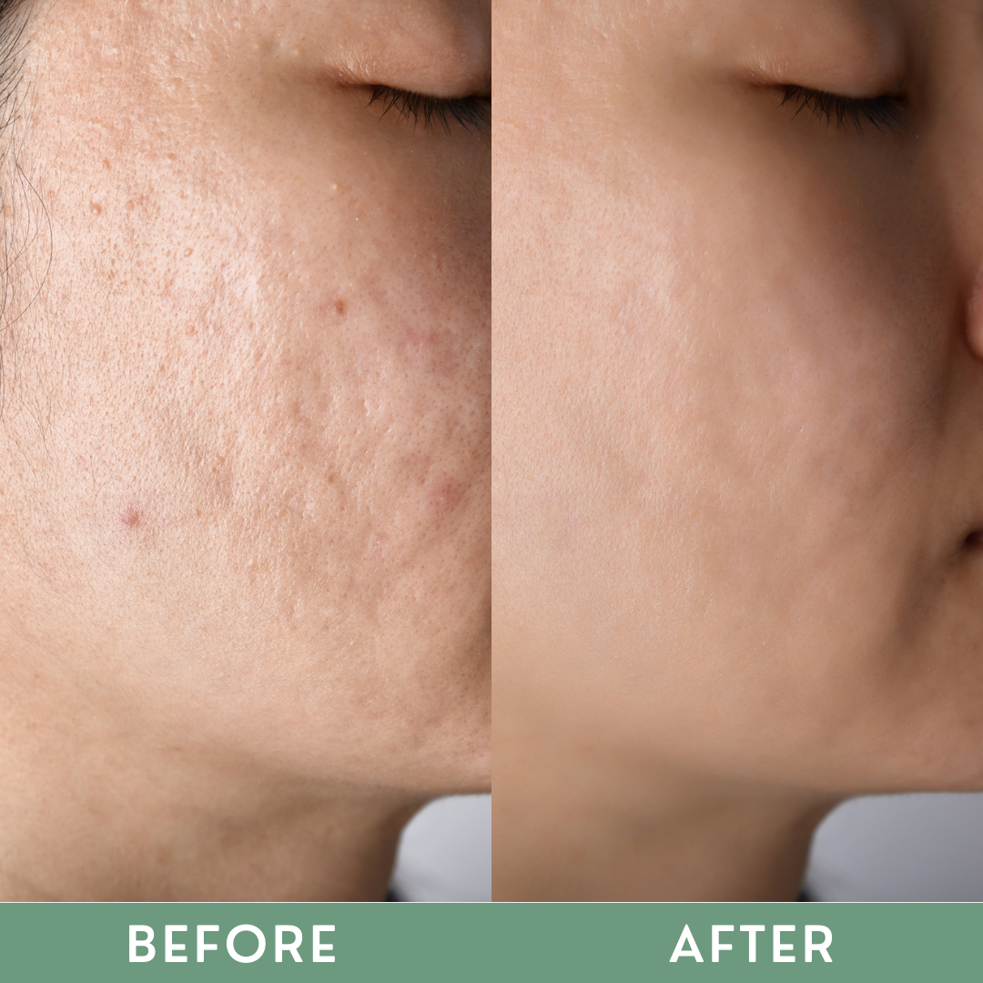 Greenika Scar Healing Gel
