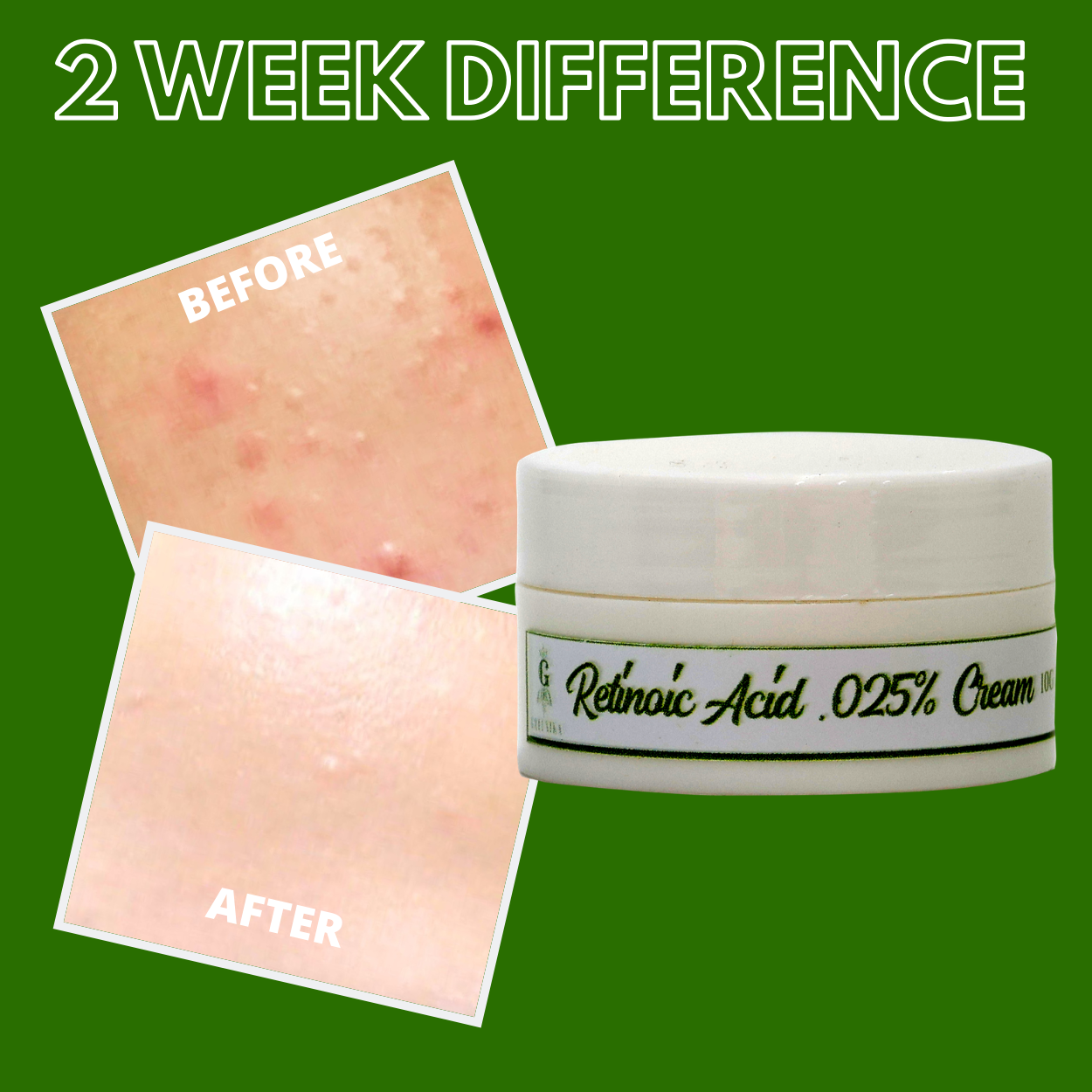 Greenika Retinoic Acid Cream