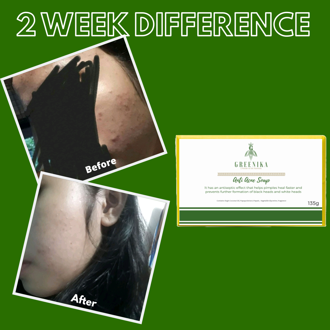 Greenika Anti Acne Soap