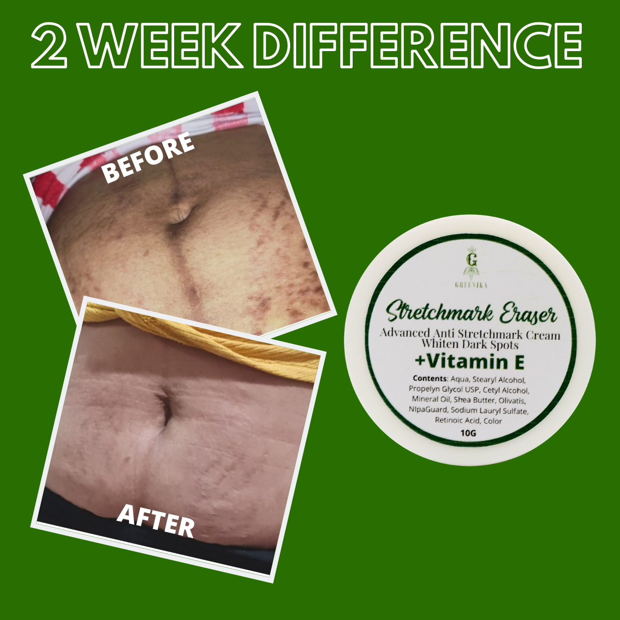 Greenika Stretch Mark Cream Dark Spot Remover