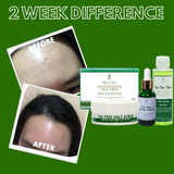 Greenika Tea Tree 4 Pc Anti Acne Set