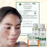 Greenika Melasma Set for Melasma Treatment