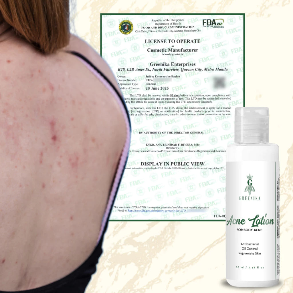 Greenika Acne Lotion for Arms Back and Body