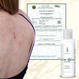 Greenika Acne Lotion for Arms Back and Body