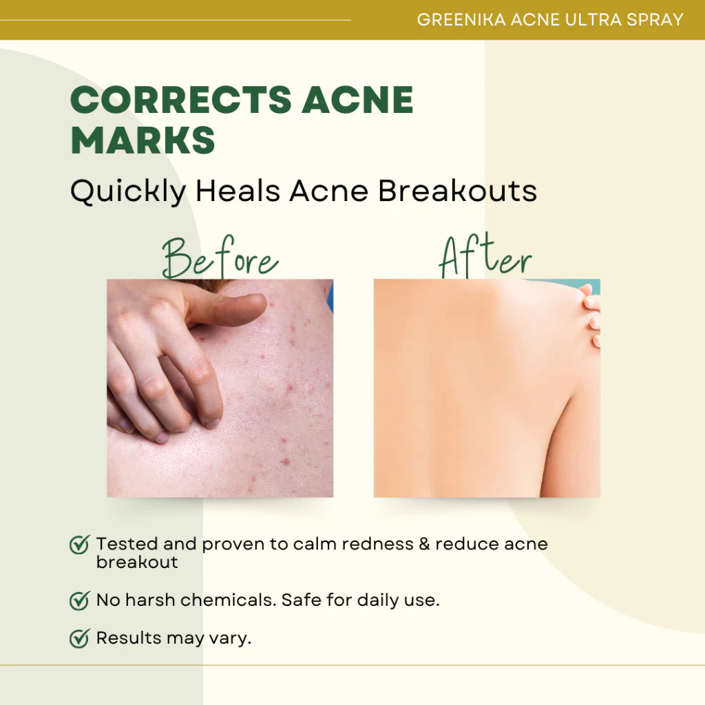 Greenika Acne-Free Acne Body Spray
