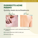Greenika Acne-Free Acne Body Spray