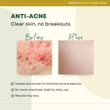 Greenika Anti-Acne Soap