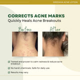 Greenika Acne Lotion for Arms Back and Body