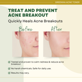 Greenika Acne Toner (Formerly Erythromycin 2% Solution)