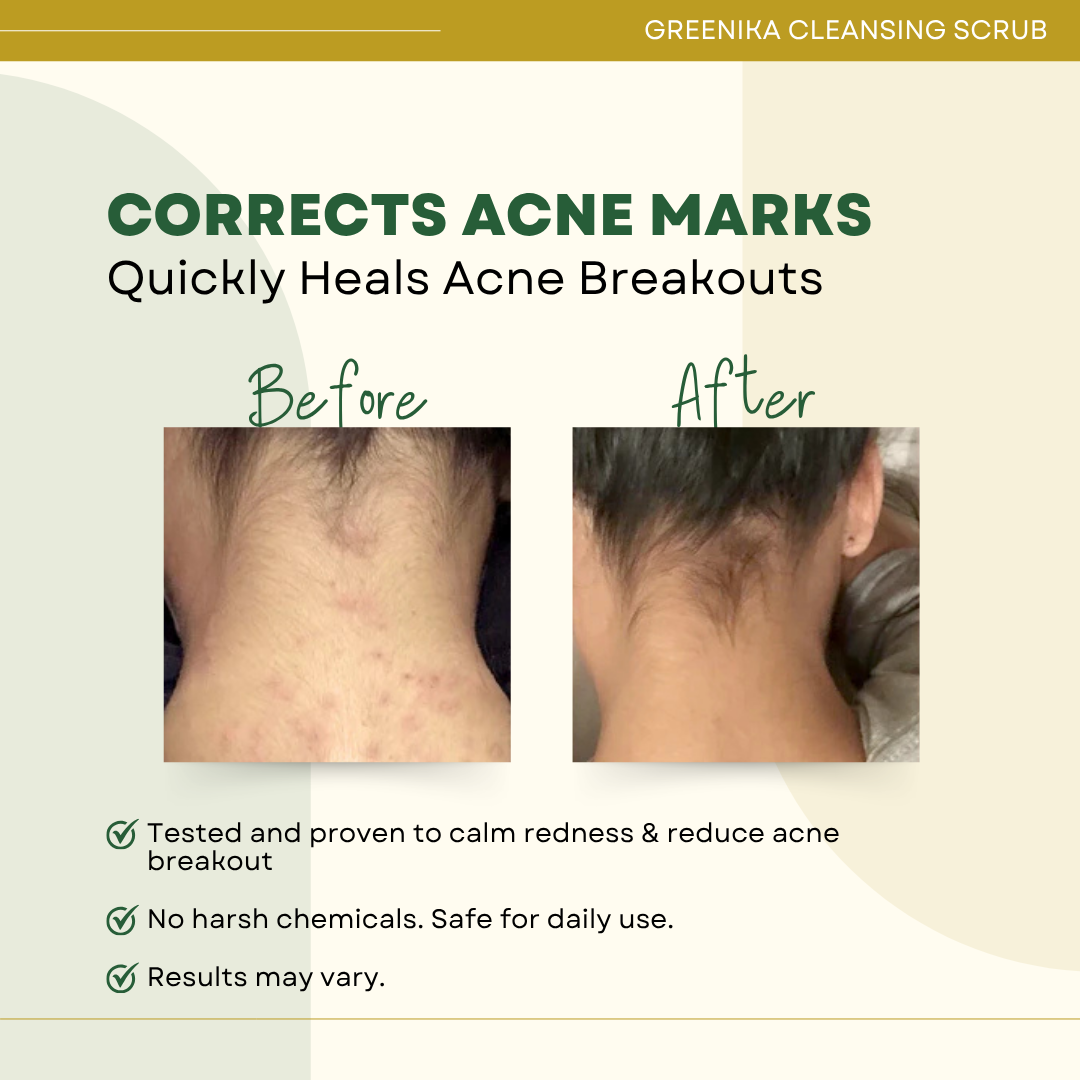 Greenika Anti Acne Black Heads Remover Cleansing Facial Scrub