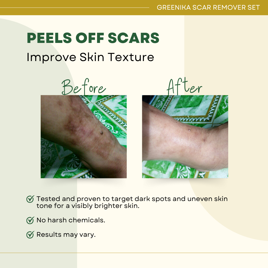 Greenika Scar Remover 4 PC Set