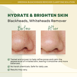 Greenika Blackhead Remover Whitehead Remover Facial Toner