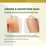 Greenika Stretch Mark Cream