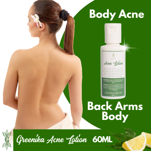 Greenika Acne Lotion for Arms Back and Body