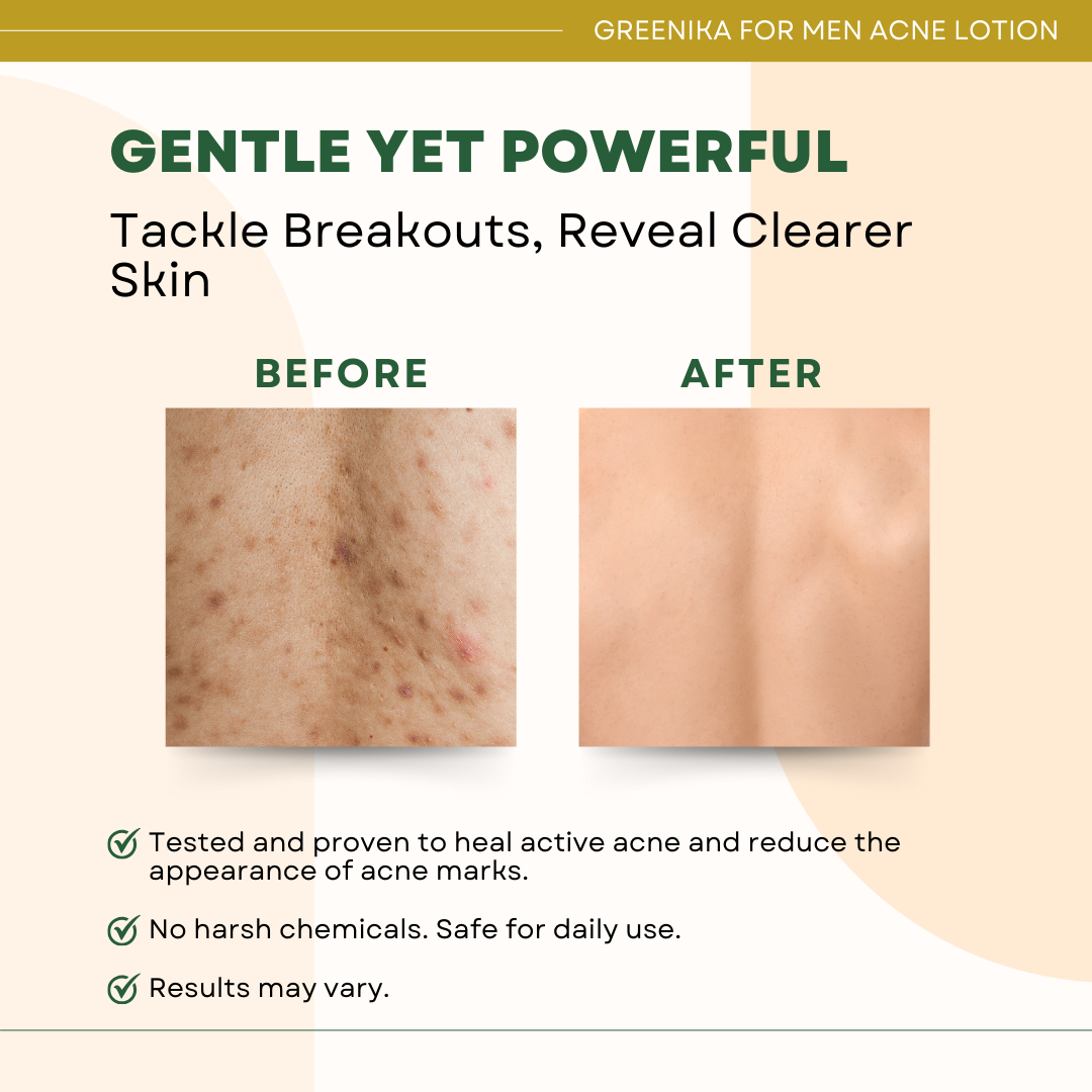 Greenika For Men Body Acne Healing Lotion