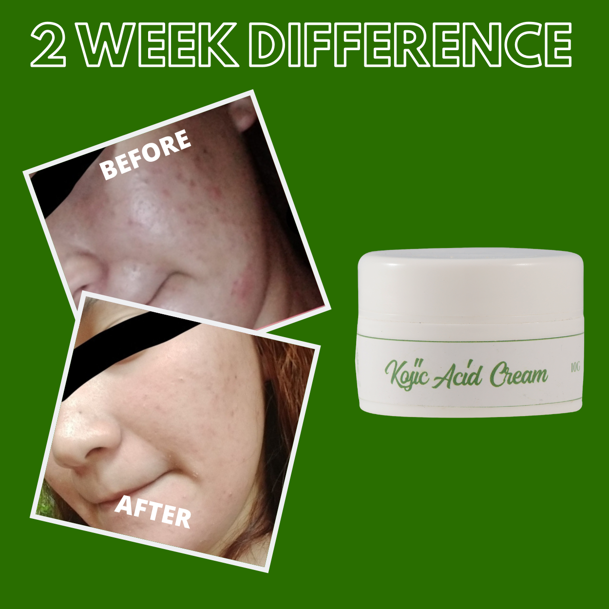 Greenika Kojic Acid Whitening Cream